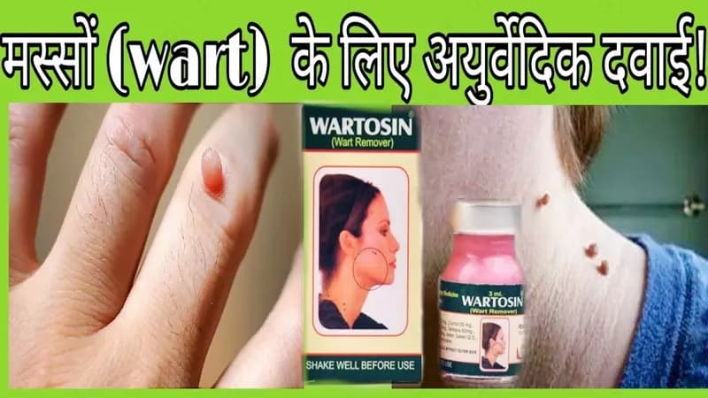 Вартосин от бородавок и папиллом (Wartosin Wart Remover) — 4