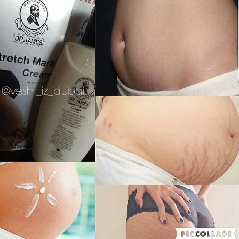 Dr. James Stretch Mark Cream / Крем для устранения растяжек Доктор Джеймс (200 мл) — 2