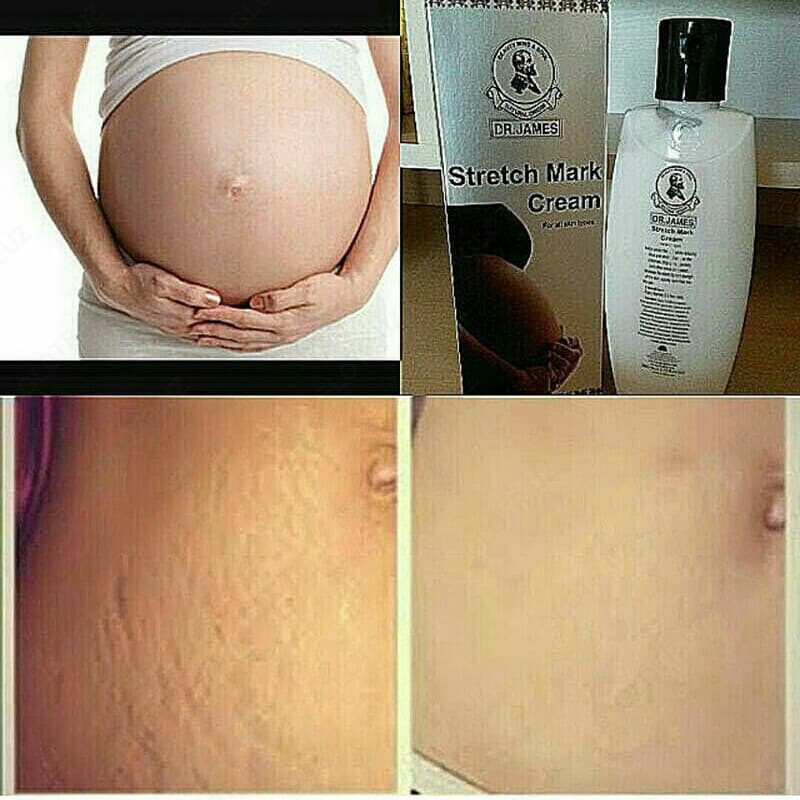 Dr. James Stretch Mark Cream / Крем для устранения растяжек Доктор Джеймс (200 мл) — 3