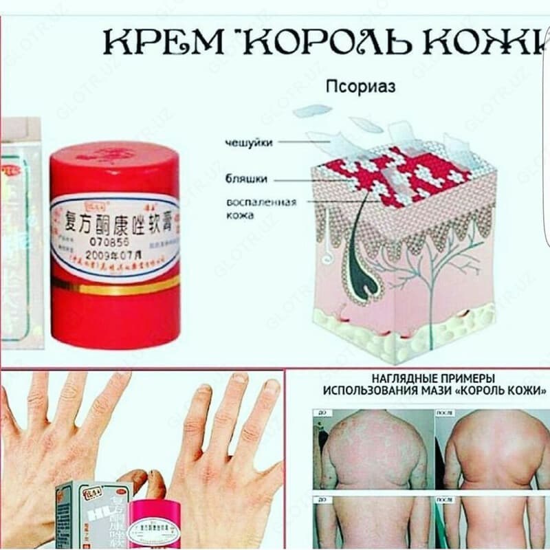 ТАЙСКАЯ МАЗЬ КОРОЛЬ КОЖИ ОТ ПСОРИАЗА — 2