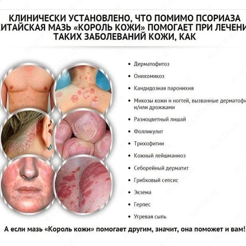 ТАЙСКАЯ МАЗЬ КОРОЛЬ КОЖИ ОТ ПСОРИАЗА — 3