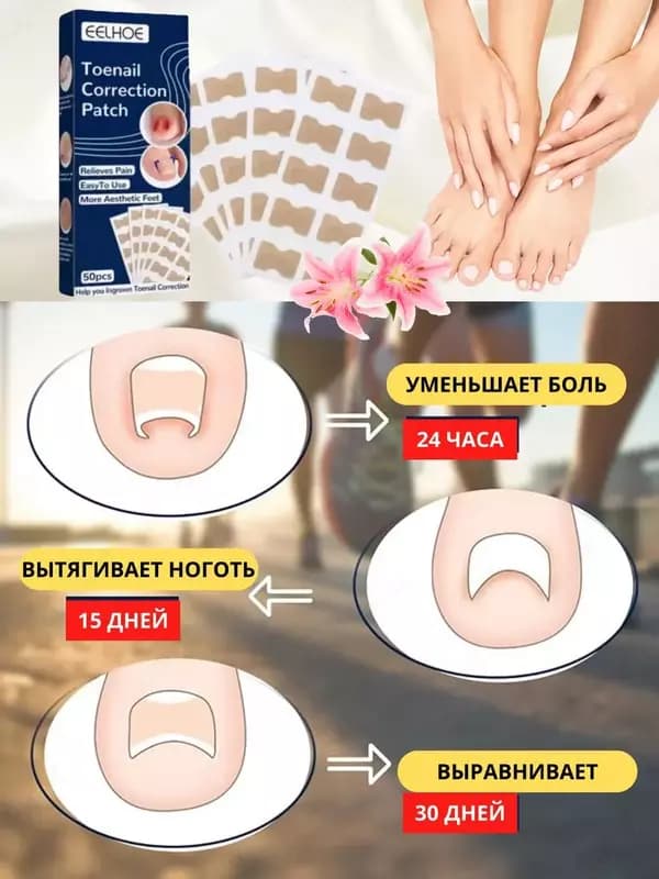 Наклейки для коррекции вросшего ногтя (50 шт). — 4