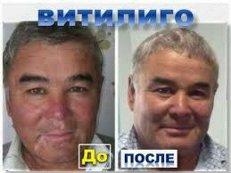 Настойка для лечения Витилиго 50мл — 2