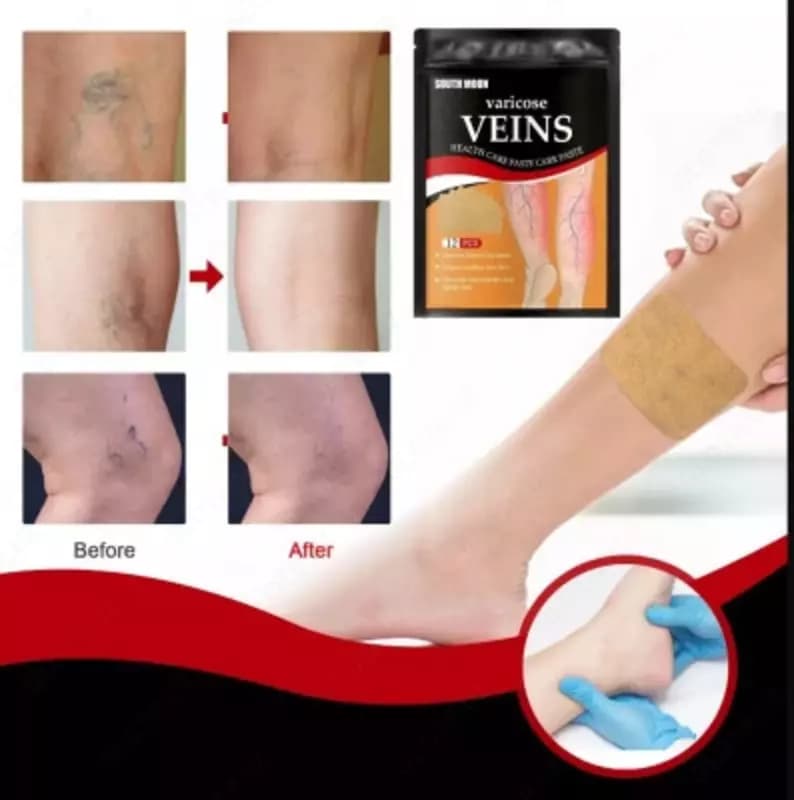 Varicose Veins Patch высокоэффективный пластырь от варикоза (Varikoz plastir) — 4