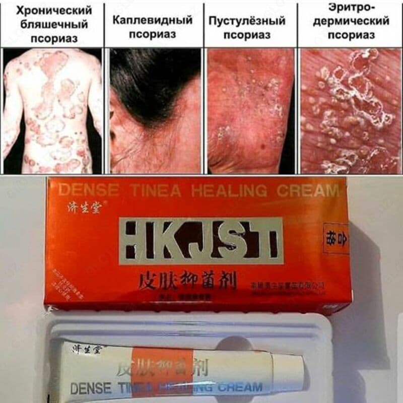 Крем от псориаза DENSE TINEA HEALING CREAM — 1
