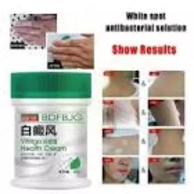 Восстанавливающий Крем Vitiligo, корректор пигментации, лечение микоза, ринчервь, белые пятна, антибактериальное лечение, Лечебный крем от з... — 1
