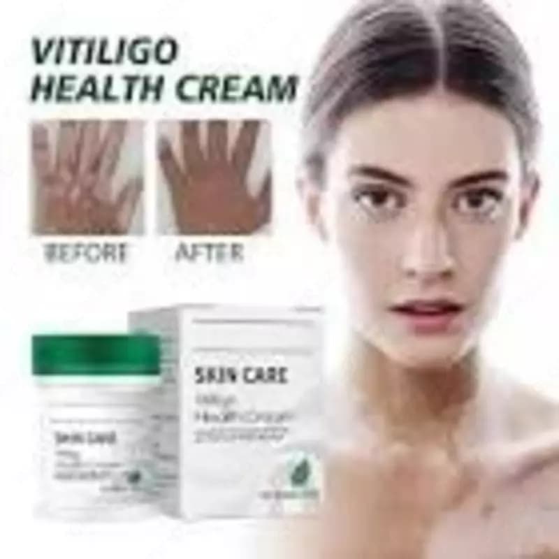 Восстанавливающий Крем Vitiligo, корректор пигментации, лечение микоза, ринчервь, белые пятна, антибактериальное лечение, Лечебный крем от з... — 2
