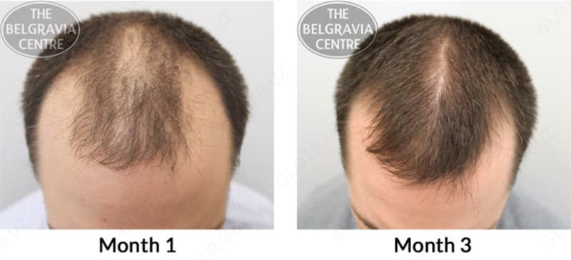 Миноксидил (minoxidil) Member's Mark для роста бороды и волос — 3