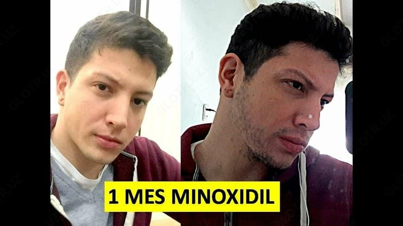 Миноксидил (minoxidil) Member's Mark для роста бороды и волос — 6
