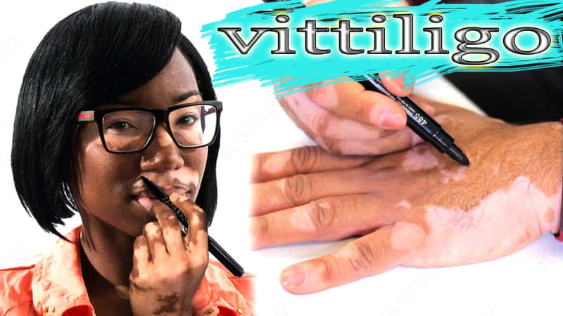Тональный фломастер от Витилиго Zanderm Vitiligo Concealer — 2