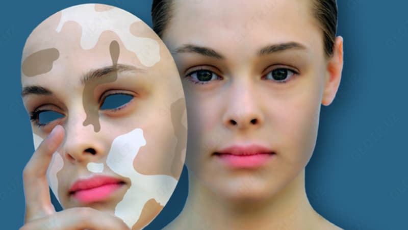 Тональный фломастер от Витилиго Zanderm Vitiligo Concealer — 4