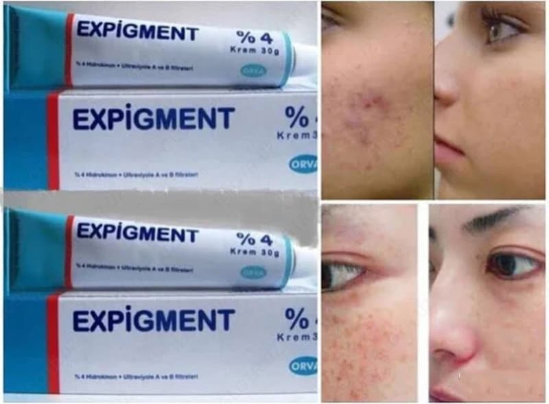 Крем отбеливающий Expigment — 2