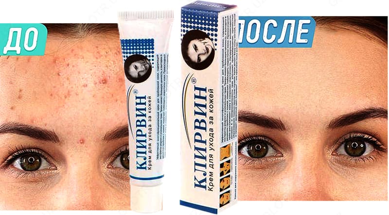 Клирвин (против пятен прыщей и шрамов на коже) — 1