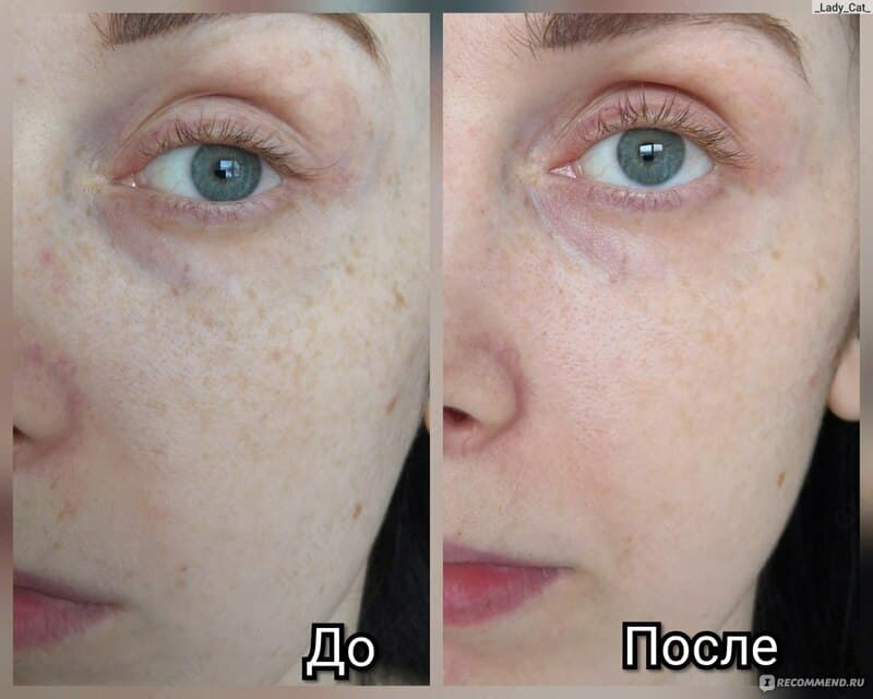 Отбеливающий крем Achroactive® Max — 8