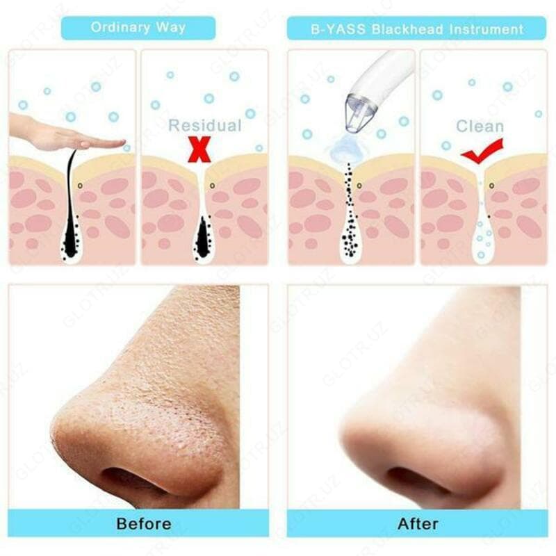Вакуумный очиститель пор лица Derma Suction — 4