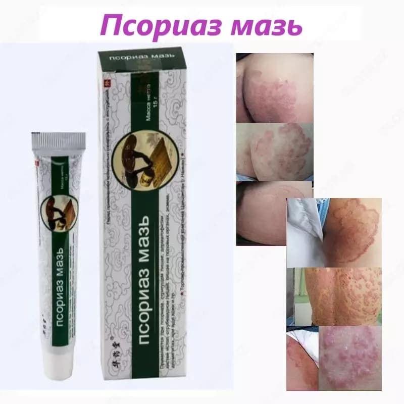 Мазь против псориаза — 4