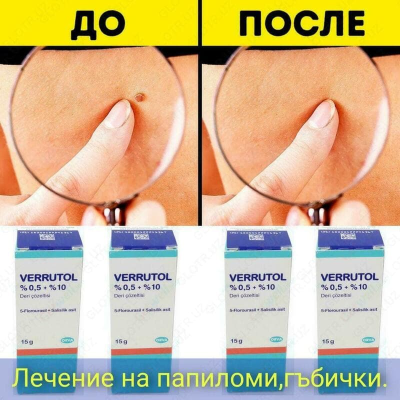 Веррутол (Verrutol) для удаления папилом — 2