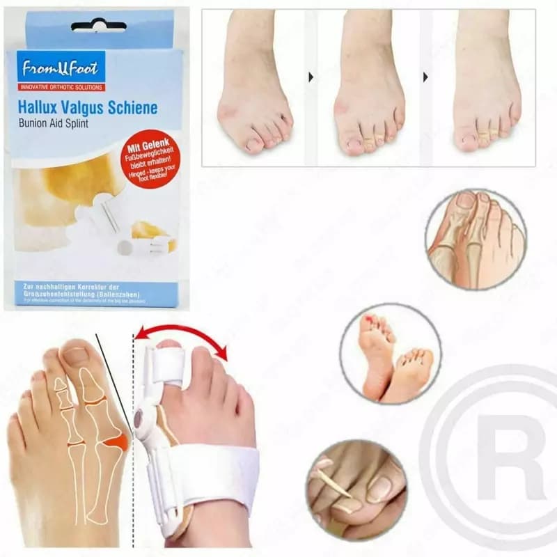 Шина Hallux valgus — 2
