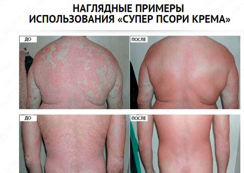 Крем Супер Псори — 4