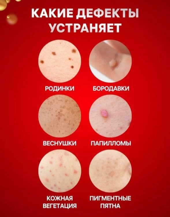 Lazer ruchka, koagulyator, papiloma, sig'il uchun kosmetik vosita — 3