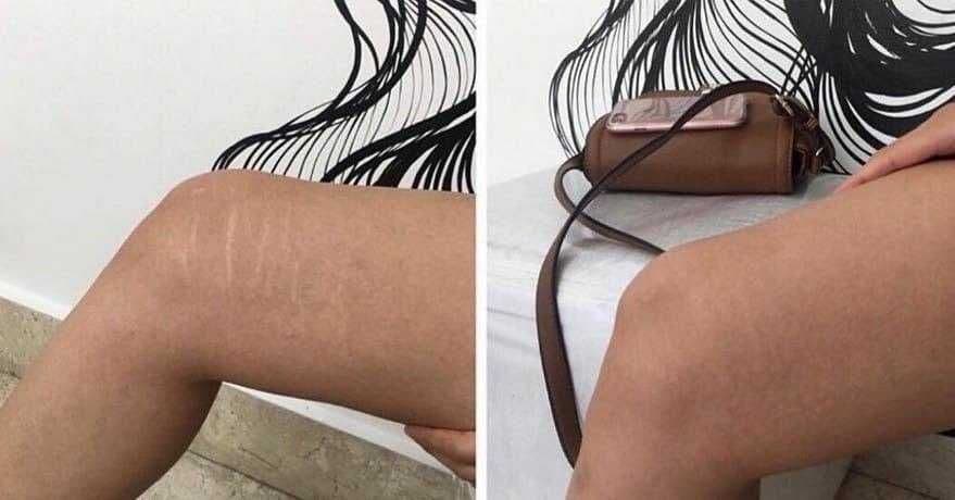 Тату,татуировка,ветелиго ,шрамы,расстяжки, курсы тату обучение! — 7