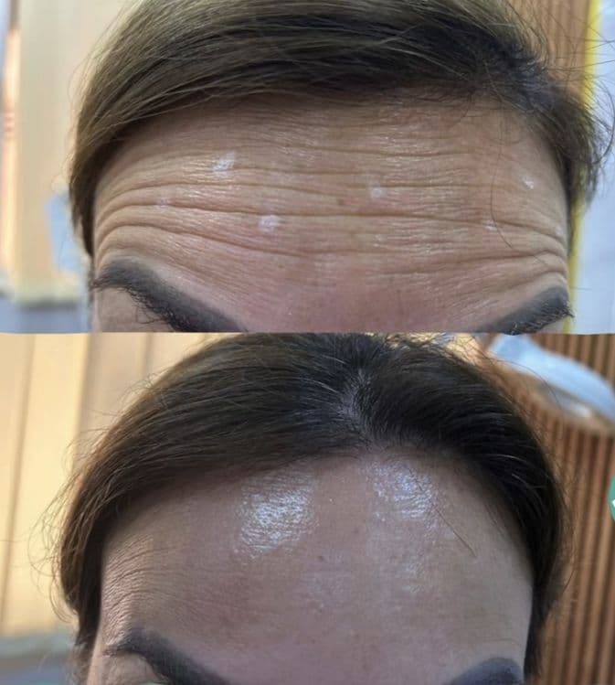Botoks, fulface, ajinlarni yùqotish. Ботокс  ,Фулфейс, Траптокс, — 1