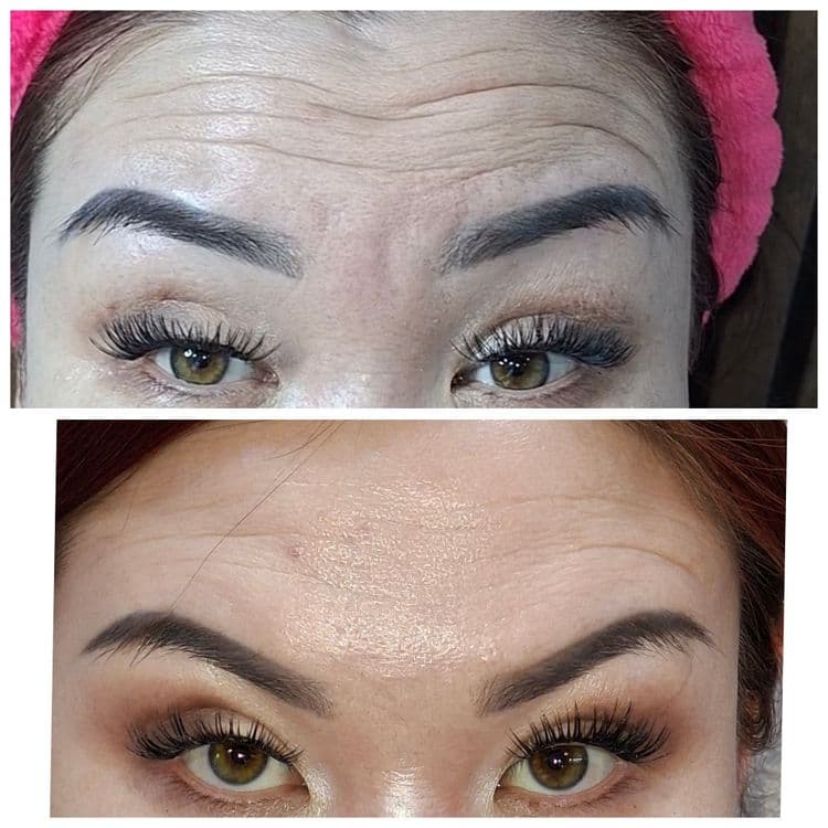 Botoks, fulface, ajinlarni yùqotish. Ботокс  ,Фулфейс, Траптокс, — 2