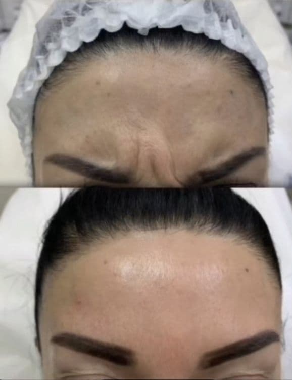 Botoks, fulface, ajinlarni yùqotish. Ботокс  ,Фулфейс, Траптокс, — 4
