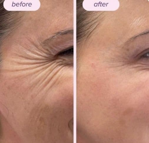 Botoks, fulface, ajinlarni yùqotish. Ботокс  ,Фулфейс, Траптокс, — 5