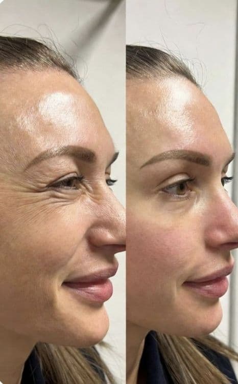 Botoks, fulface, ajinlarni yùqotish. Ботокс  ,Фулфейс, Траптокс, — 6