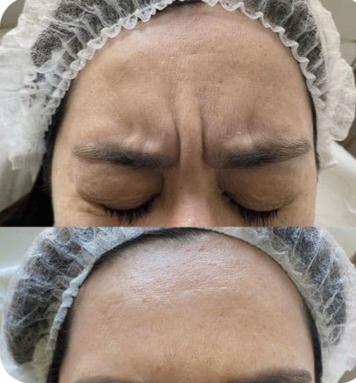 Botoks, fulface, ajinlarni yùqotish. Ботокс  ,Фулфейс, Траптокс, — 7