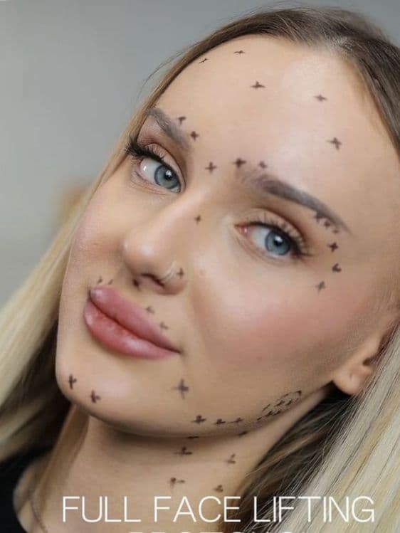 Botoks, fulface, ajinlarni yùqotish. Ботокс  ,Фулфейс, Траптокс, — 8