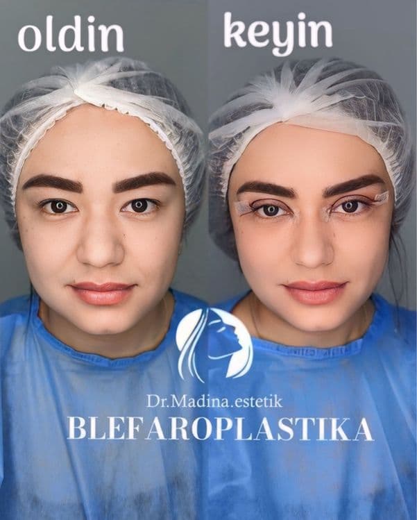 -50% CHEGIRMADA Blefaroplastika — 2