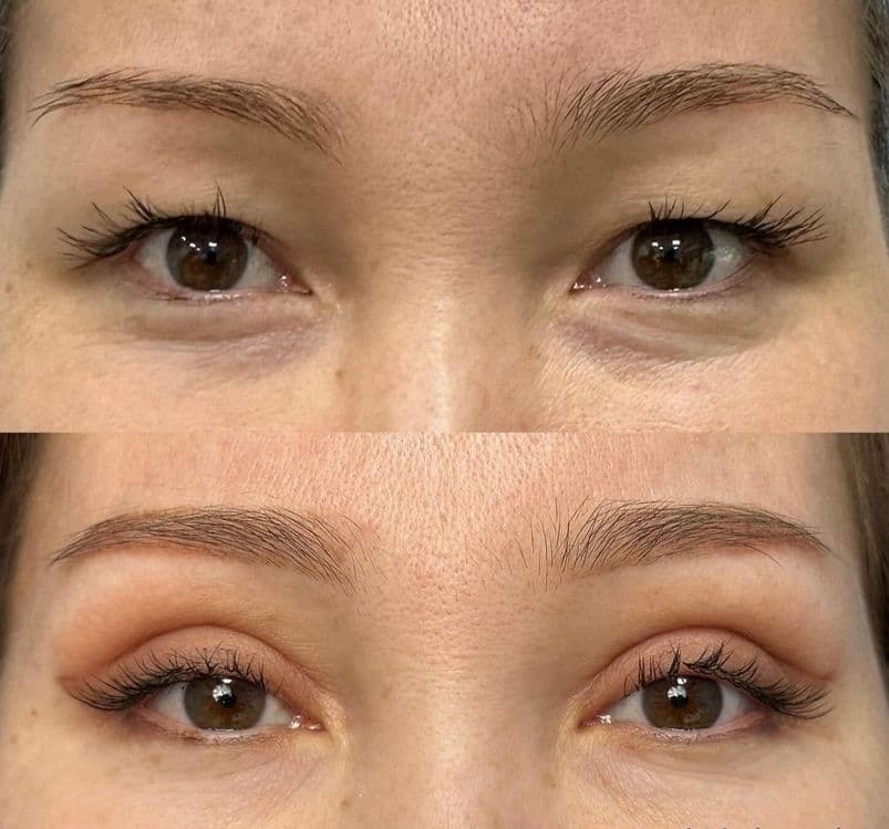 -50% CHEGIRMADA Blefaroplastika — 3