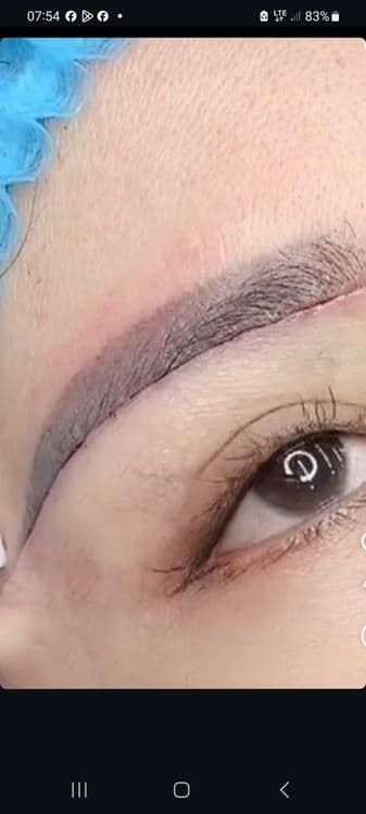 -50% CHEGIRMADA Blefaroplastika — 4