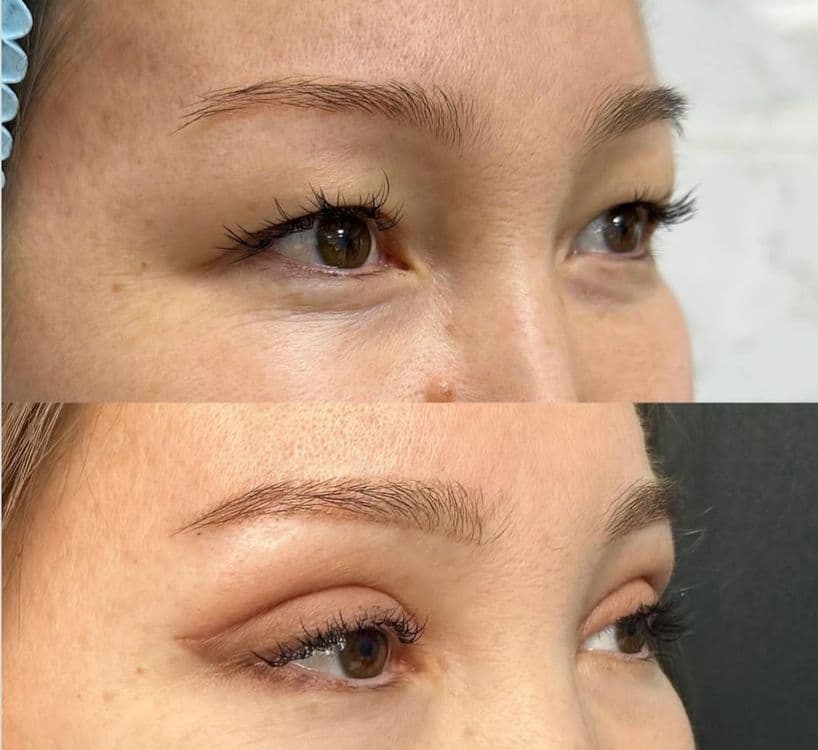 -50% CHEGIRMADA Blefaroplastika — 5