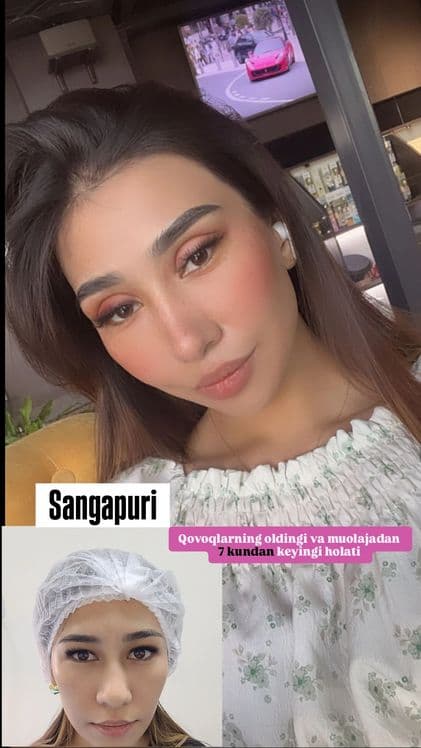 -50% CHEGIRMADA Blefaroplastika — 6