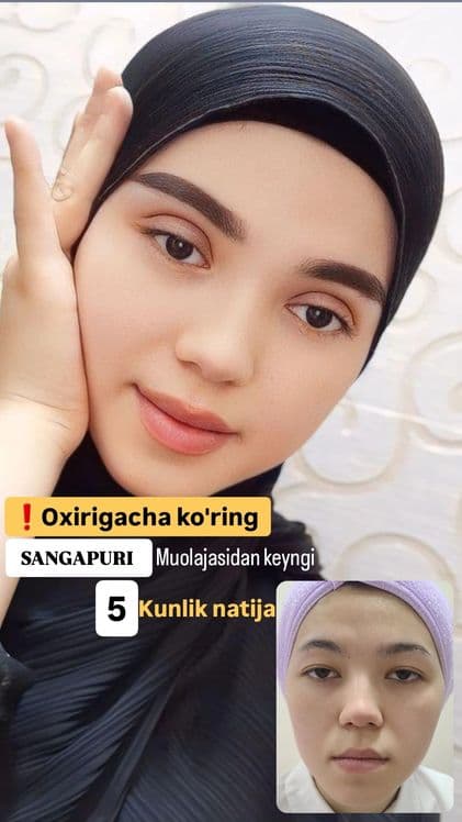 -50% CHEGIRMADA Blefaroplastika — 7