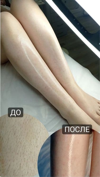Depilyatsiya skidkada — 6