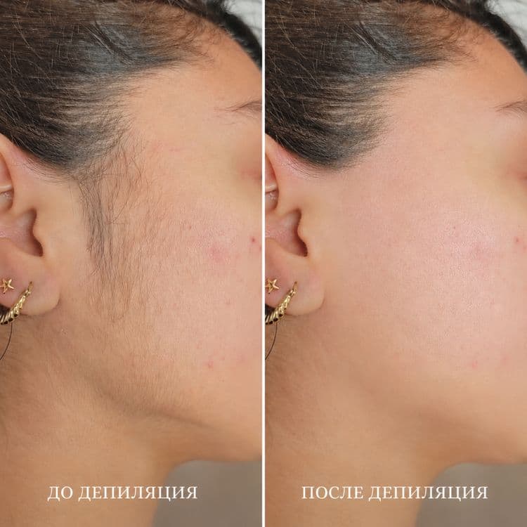 Депиляция хизмати фақат аёллар учун — 2