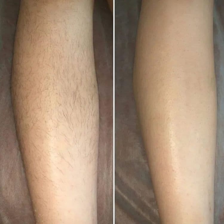 ШУГАРИНГ Сахарная депиляция — 1