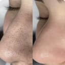 Yuzni chishtka qilish. Чистка лица.