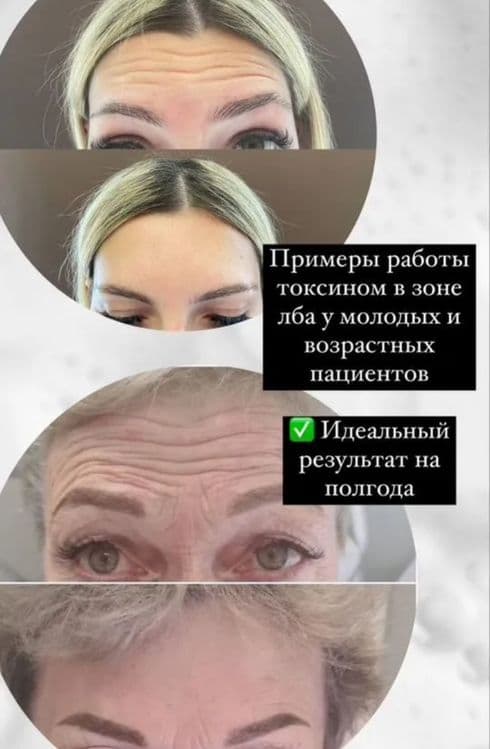 Ботокс. Лоб,межбровка,глаза — 1