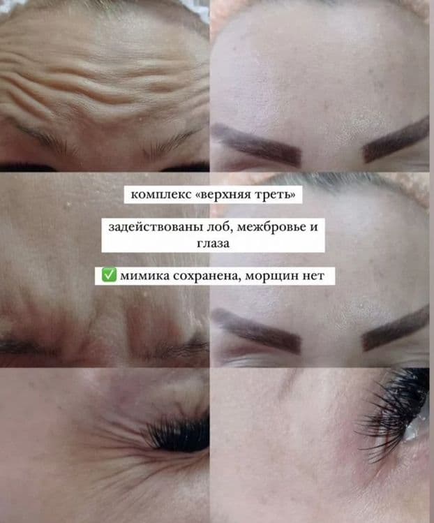 Ботокс. Лоб,межбровка,глаза — 2