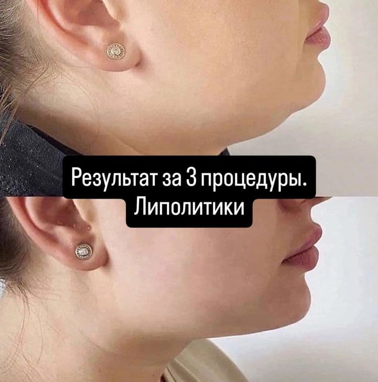 Скидки на ботокс! Диспорт (DYSPORT) — 2