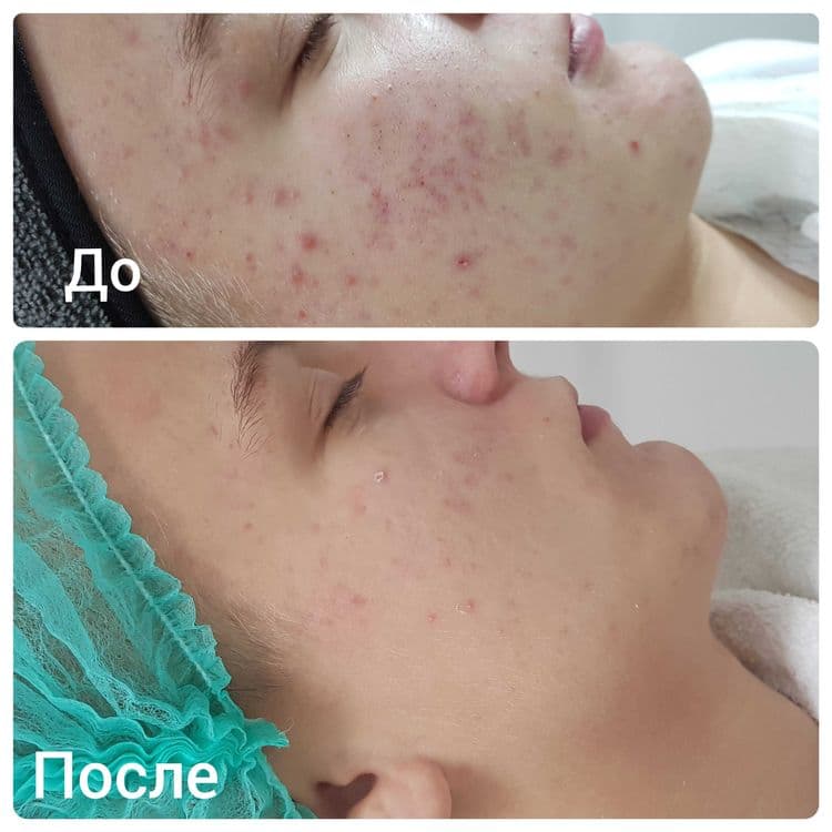 Чистка лица, Yuz tozalash, косметолог. — 1
