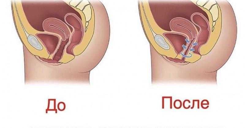 Интимное омоложение. Безоперационное лазерное интимное сужение. — 2