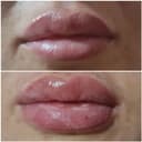Botox v Tashkente,Kosmetolog