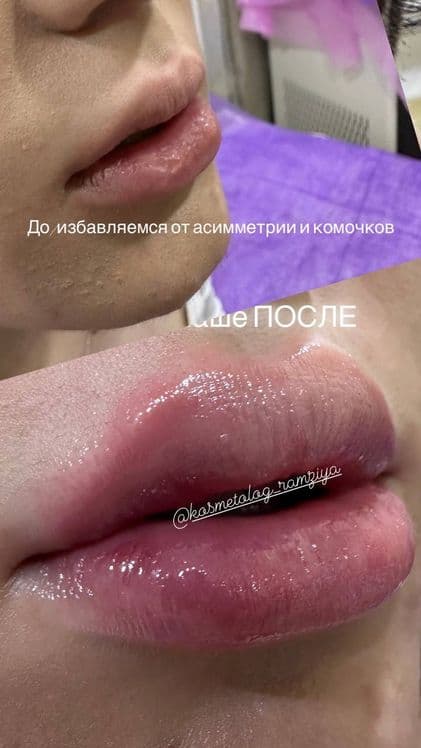Косметологические услуги (мужчины и женщины) ,фуллфейз ботокс, губы — 3
