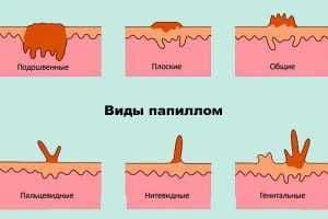 Лазерное удаление папиллом и бородавок на дому, в клинике коагулятором — 3
